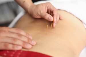 Acupuncture