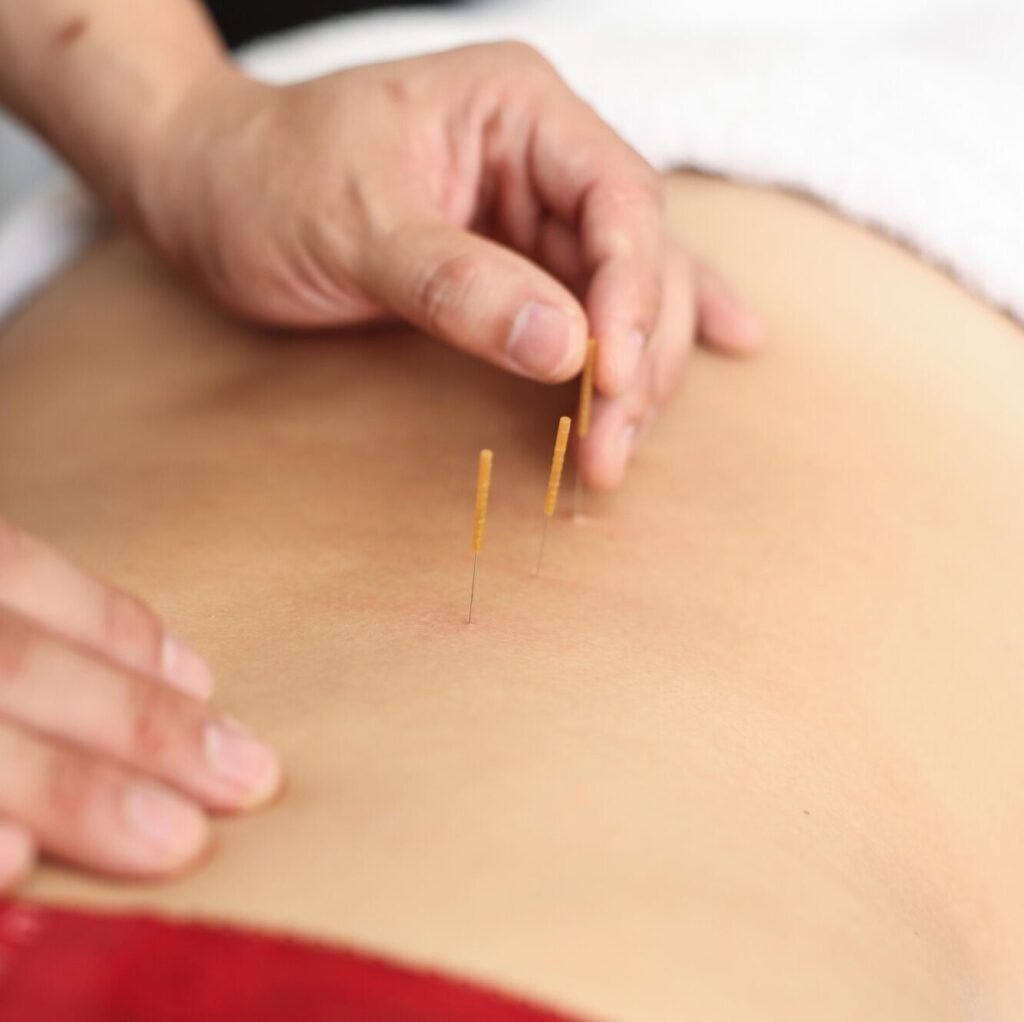 Acupuncture