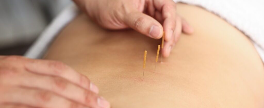 Acupuncture at Richmond Osteopaths