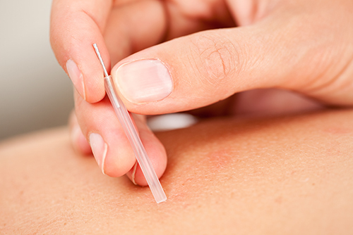 Have you considered Acupuncture?